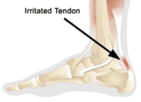 ACHILLES TENDONITIS