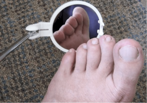 Diabetic Foot