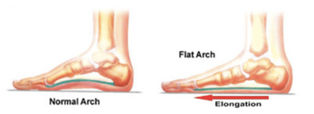 FlatFeet