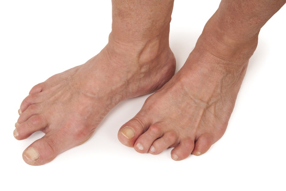 Rheumatoid Foot