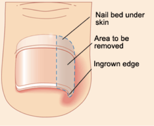 ToenailSurgery